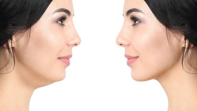 Corrective Jaw Surgery