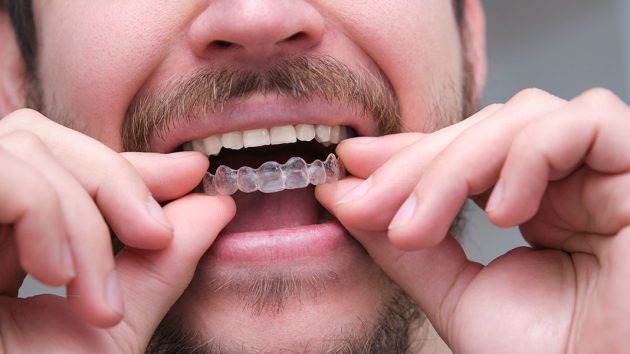 Can Invisalign fix severe orthodontic cases — expert answer from Liverpool Orthodontics specialist NSW