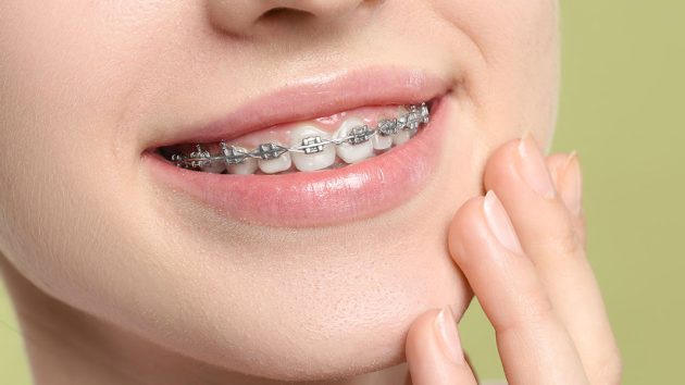 How to handle braces discomfort tips from orthodontists — Liverpool Orthodontics Liverpool NSW